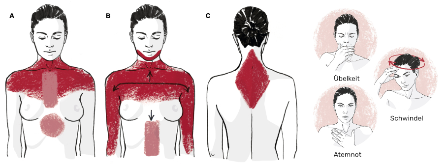 Frauenherzinfarkt, Grafik von Deutsche Herzstiftung e.V.